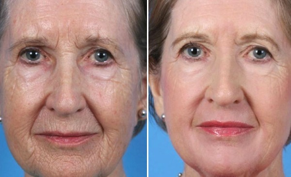 Пластична хирургија лица. Фотографије пре и после операције контурирања хијалуронском киселином. Цене, прегледи