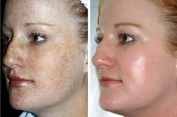 Phẫu thuật tạo hình khuôn mặt. Hình ảnh trước và sau khi phẫu thuật tạo đường nét bằng axit hyaluronic. Giá cả, đánh giá