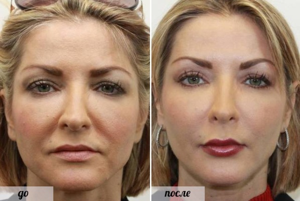Pembedahan plastik muka. Foto sebelum dan selepas pembedahan kontur dengan asid hyaluronik. Harga, ulasan
