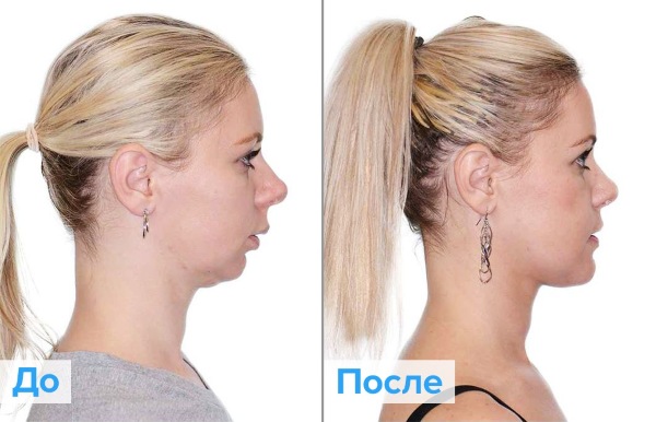 Facial plastische chirurgie. Foto's voor en na een contouroperatie met hyaluronzuur. Prijzen, recensies