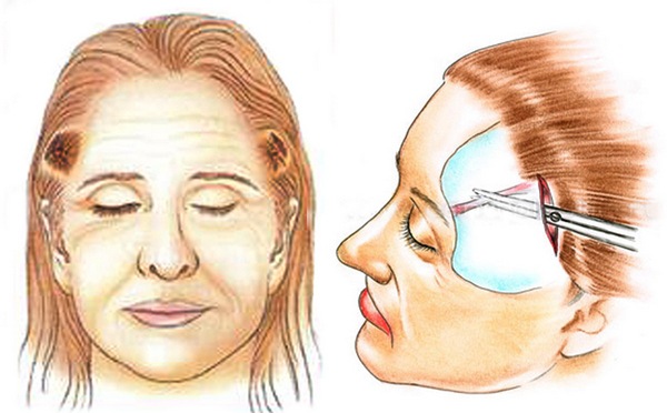 Chirurgie plastique faciale. Photos avant et après la chirurgie de contouring à l'acide hyaluronique. Prix, avis