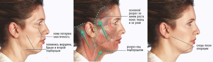 Cirurgia plástica facial. Fotos antes e depois da cirurgia de contorno com ácido hialurônico. Preços, comentários