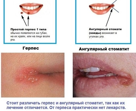 The reasons why lips dry in women, men. How to treat colds, acute respiratory viral infections, menopause, diabetes, oncology, during pregnancy