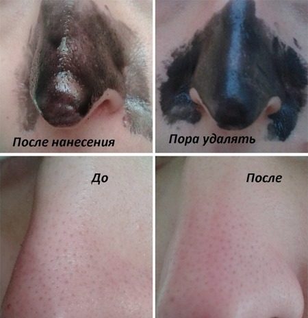 Comment se débarrasser des points noirs sur le visage, le nez, les oreilles. Produits avec acide salicylique, dentifrice, peroxyde, charbon actif
