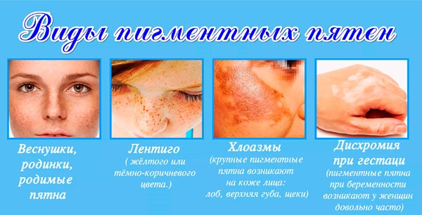 Remedies for age spots on the face and hands. Folk recipes, pharmacy preparations, creams: Melanativ, Vichy, Sabainang. How to apply