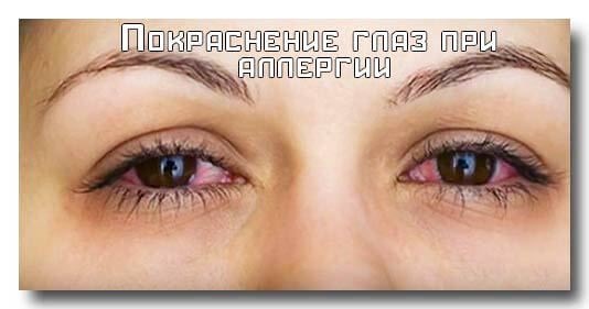انتفاخات داكنة تحت العينين ، دوائر حول العينين. الأسباب والعلاج عند النساء والرجال