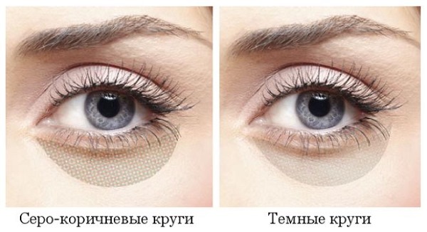 Σκούρες τσάντες κάτω από τα μάτια, κύκλοι γύρω από τα μάτια. Αιτίες και θεραπεία σε γυναίκες και άνδρες