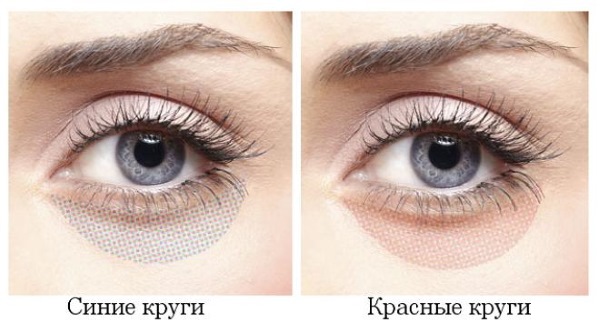 Σκούρες τσάντες κάτω από τα μάτια, κύκλοι γύρω από τα μάτια. Αιτίες και θεραπεία σε γυναίκες και άνδρες