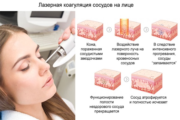 Suppression des varicosités sur le visage avec un laser. Contre-indications, conséquences. Prix, avis