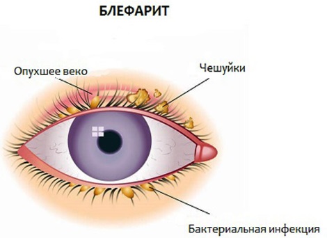 Blefarogel 2. Arahan penggunaan, cara memohon barli, untuk wajah, kelopak mata, pertumbuhan bulu mata, untuk pembengkakan di bawah mata.Analog