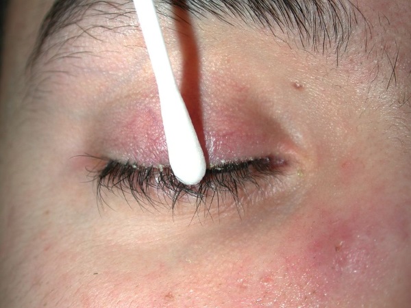 Blefarogel 2. Gebrauchsanweisung, Anwendung von Gerste, Gesicht, Augenlidern, Wimpernwachstum, Schwellung unter den Augen. Analoge