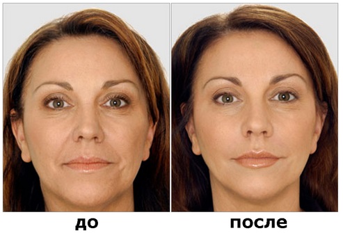 Botulino terapija kosmetologijoje - kas tai, efektyvumas ir rezultatai, apžvalgos. „Dysport“, „Xeomin“, „Botox“
