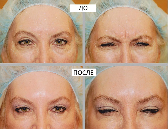 Botulinumterapi inom kosmetologi - vad är det, effektivitet och resultat, recensioner. Dysport, Xeomin, Botox