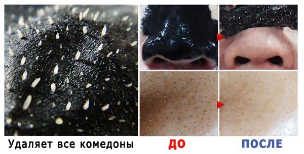 Black mask for blackheads and acne. Recipes, how to make, apply at home, how much to keep