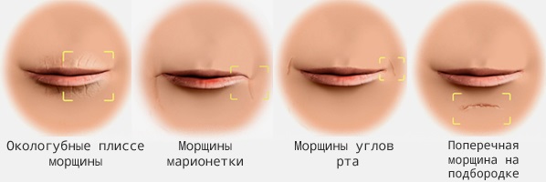 Acide hyaluronique pour les lèvres: photos avant et après, avantages et inconvénients, effet, contre-indications. Prix ​​de la procédure et avis
