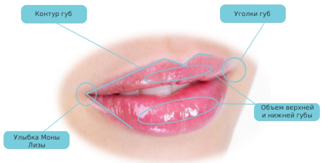 Lèvres avant et après photo d'acide hyaluronique avant et après l'augmentation. Combien de temps dure l'effet lorsque l'œdème disparaît