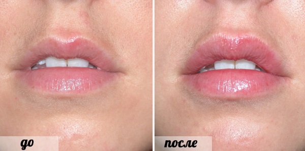 Foto dos lábios antes e depois do ácido hialurônico antes e depois do aumento. Quanto tempo dura o efeito quando o edema desaparece