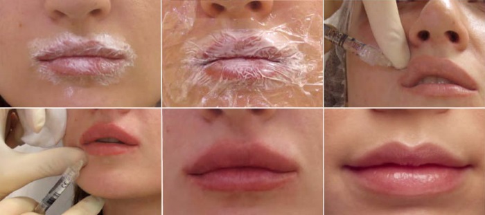 Lūpos prieš ir po hialurono rūgšties nuotraukos prieš ir po padidinimo. Kiek laiko trunka efektas, kai išnyksta edema