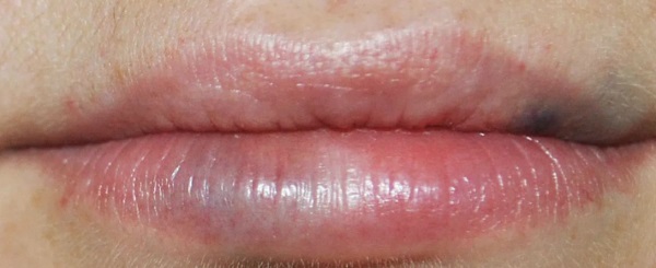 ริมฝีปากก่อนและหลังภาพถ่ายกรดไฮยาลูโรนิกก่อนและหลังการเสริม ผลจะคงอยู่นานแค่ไหนเมื่ออาการบวมน้ำหายไป