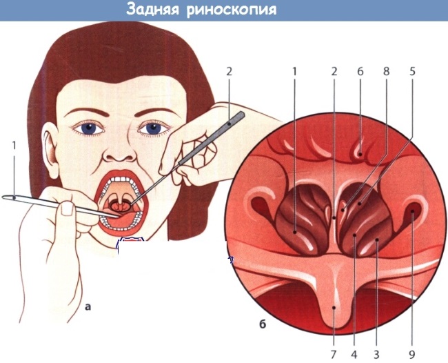 Courbure de la cloison nasale. Traitement sans chirurgie avec des remèdes populaires, conservateur, laser