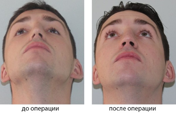 Curvatura do septo nasal. Sintomas, causas e consequências. Operação de septoplastia: indicações, contra-indicações, tipos e características