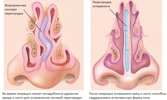 Curvatura do septo nasal. Sintomas, causas e consequências. Operação de septoplastia: indicações, contra-indicações, tipos e características