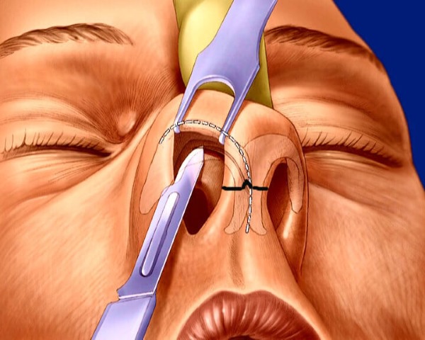 Curvatura de l’envà nasal. Símptomes, causes i conseqüències. Operació de septoplàstia: indicacions, contraindicacions, tipus i característiques