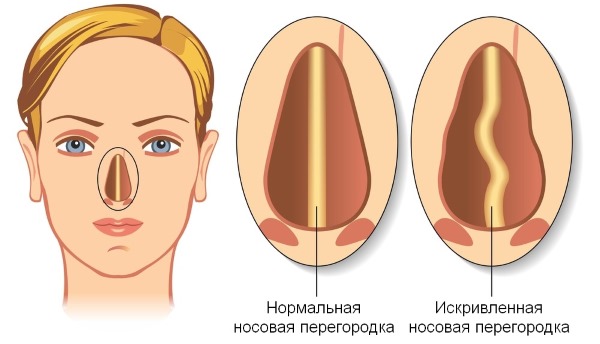 Kelengkungan septum hidung. Gejala, sebab dan akibatnya. Operasi Septoplasti: petunjuk, kontraindikasi, jenis dan ciri