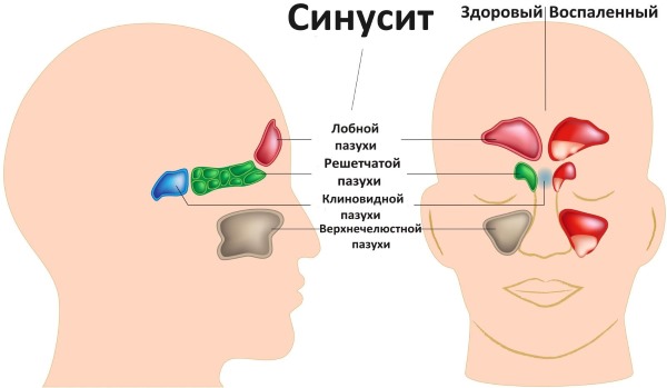 Courbure de la cloison nasale. Symptômes, causes et conséquences. Opération de septoplastie: indications, contre-indications, types et caractéristiques