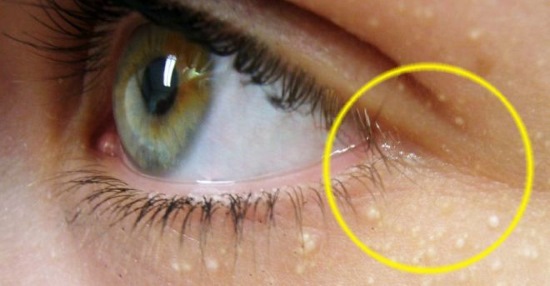 Miliums on the face. Photo, how to get rid of, treat at home, laser removal under the eyes, on the eyelids, chin, body. Causes in adults and children