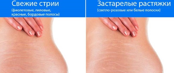 How to get rid of stretch marks, remove on the chest, stomach, buttocks, body, legs, hips after childbirth, during pregnancy.Creams, oil, mummy, laser removal