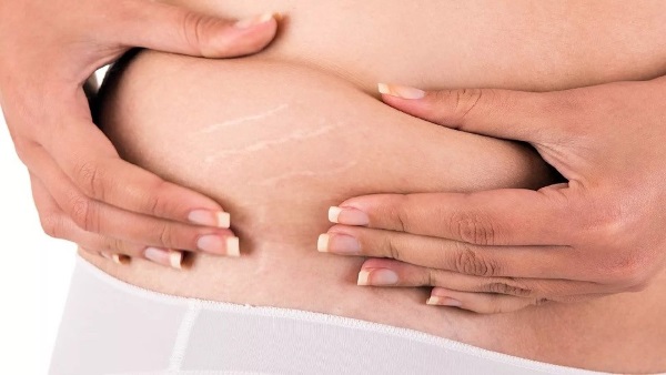 Hvordan bli kvitt strekkmerker, fjern på bryst, mage, rumpe, kropp, ben, hofter etter fødsel, under graviditet. Kremer, olje, mamma, laserfjerning