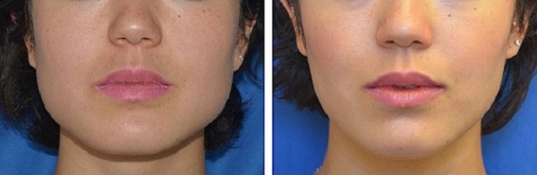Eliminació dels grumolls de Bisha. Abans i després de fotos, conseqüències, període de rehabilitació. Com eliminar-lo sense cirurgia