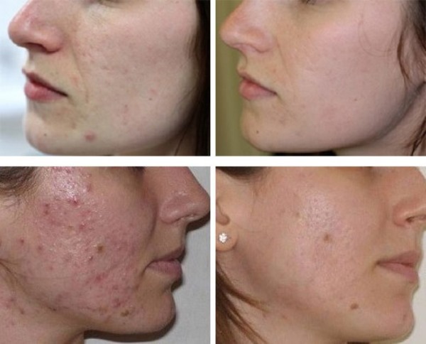 Jak používat Levomekol na akné na obličeji. Pokyny, indikace a kontraindikace