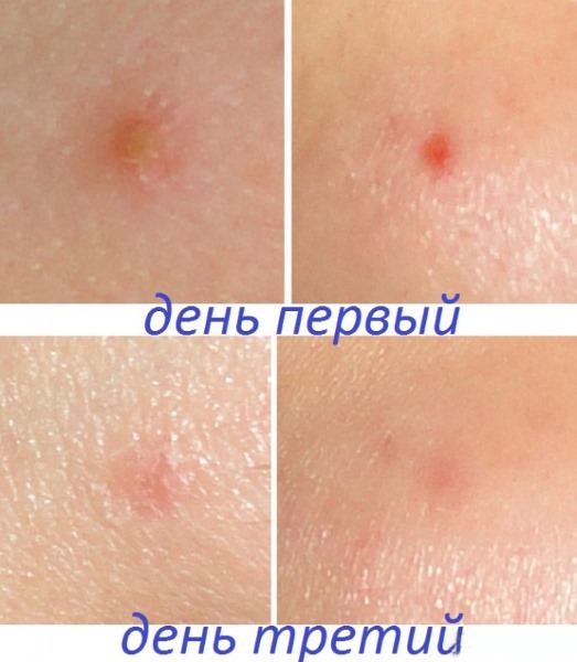 Comment utiliser Levomekol pour l'acné sur le visage. Instructions, indications et contre-indications