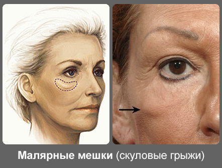 Como se livrar de sacos de tinta nas maçãs do rosto sem cirurgia, remédios populares, lipólise em cosmetologia