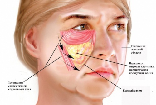 Hoe zich te ontdoen van verfzakken op de jukbeenderen zonder chirurgie, folkremedies, lipolyse in cosmetica