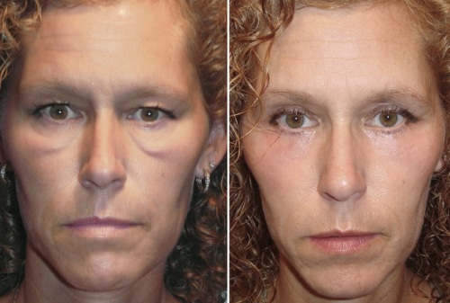 Hogyan lehet megszabadulni a festékzsákoktól az arccsonton műtét, népi gyógymódok, lipolízis nélkül a kozmetológiában