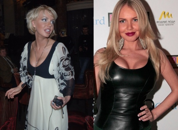 Masha Malinovskaya voor en na plastische chirurgie. Foto, leeftijd, lengte en gewicht