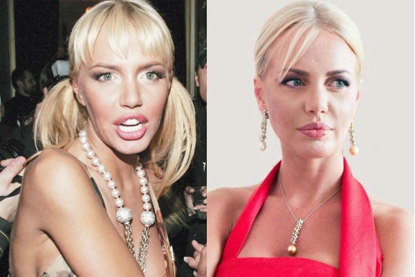 Masha Malinovskaya antes e depois da cirurgia plástica. Foto, idade, altura e peso