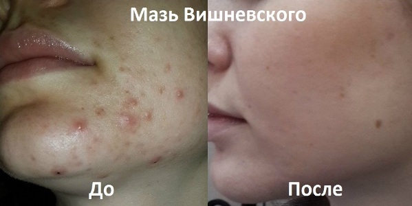 Pommades pour l'acné sur le visage: peu coûteuses et efficaces avec un antibiotique, pour les rouges, points noirs, acné, marques, pour les adolescents Noms et prix