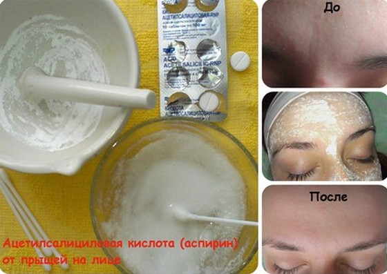 Pommades pour l'acné sur le visage: peu coûteuses et efficaces avec un antibiotique, pour les rouges, points noirs, acné, marques, pour les adolescents Noms et prix