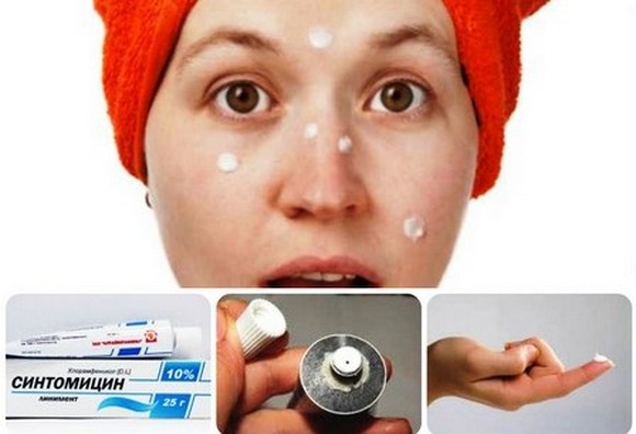 Ungüents per a l'acne a la cara: econòmic i eficaç amb un antibiòtic, per a vermells, punts negres, acne, marques, per a adolescents. Noms i preus