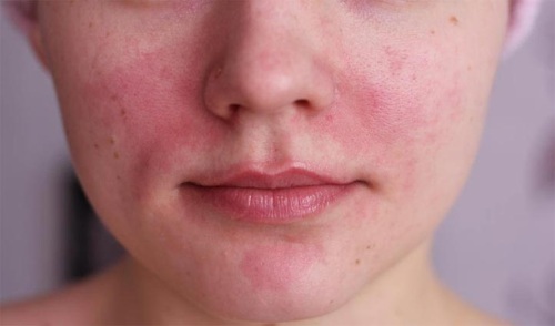Regetsin gel facial antiarrugas. Cómo aplicar ungüento, consejos de cosmetólogos, revisiones.