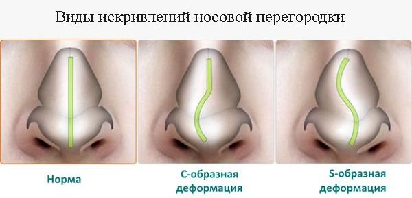 Septoplasti septum hidung.Apakah gelombang radio, endoskopik, gelombang radio ini. Tempoh selepas operasi, akibatnya