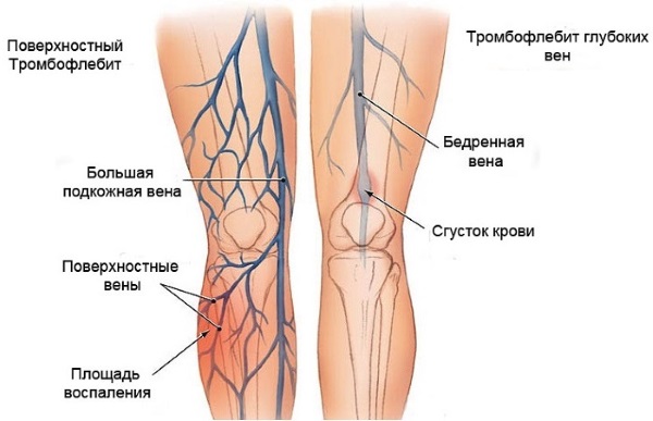 Σκληροθεραπεία φλεβών στα πόδια - ποια είναι αυτή η διαδικασία, η περίοδος αποκατάστασης, πιθανές επιπλοκές και συνέπειες