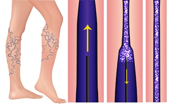 Escleroteràpia de venes a les cames: quin és aquest procediment, el període de rehabilitació, possibles complicacions i conseqüències