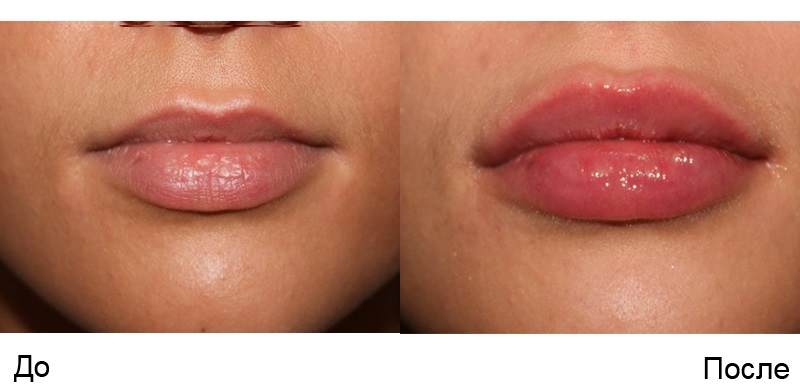 Augmentation des lèvres avec de l'acide hyaluronique, des charges, du botox, du silicone, des plastiques de contour. Photo, prix, avis
