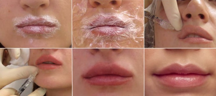 Pembesaran bibir dengan asid hyaluronik, pengisi, botox, silikon, plastik kontur. Foto, harga, ulasan