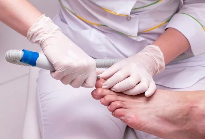 เล็บเท้าคุด สาเหตุของลักษณะอาการการรักษาโดยไม่ต้องผ่าตัดด้วยวิธีการรักษาพื้นบ้านขี้ผึ้งการผ่าตัด